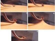 kene resimleri_resimleri 5 kene resimleri_resimleri 5